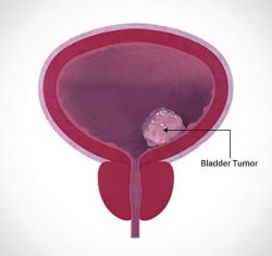 Bladder Cancer: Symptoms, Causes & Treatment