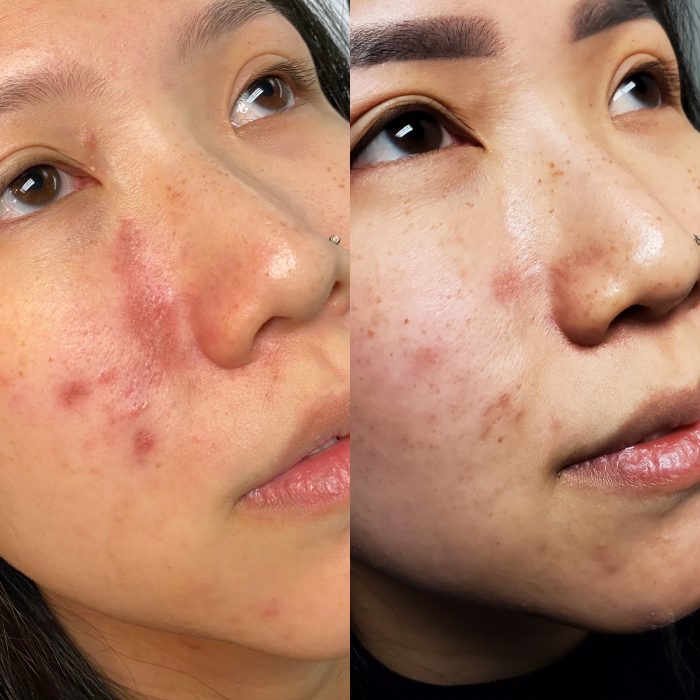 Acne scar: before and after