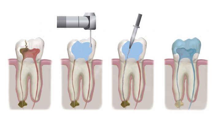 Root Canal in Houston, TX