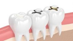 What Are The Benefits Of Getting A Tooth Filling?