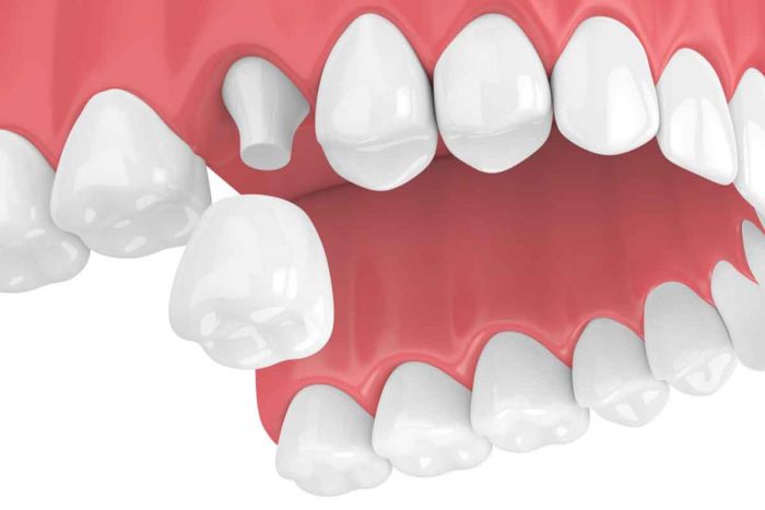 What Is There To Know About Dental Crowns?