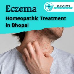 Homeopathic Treatment for Eczema
