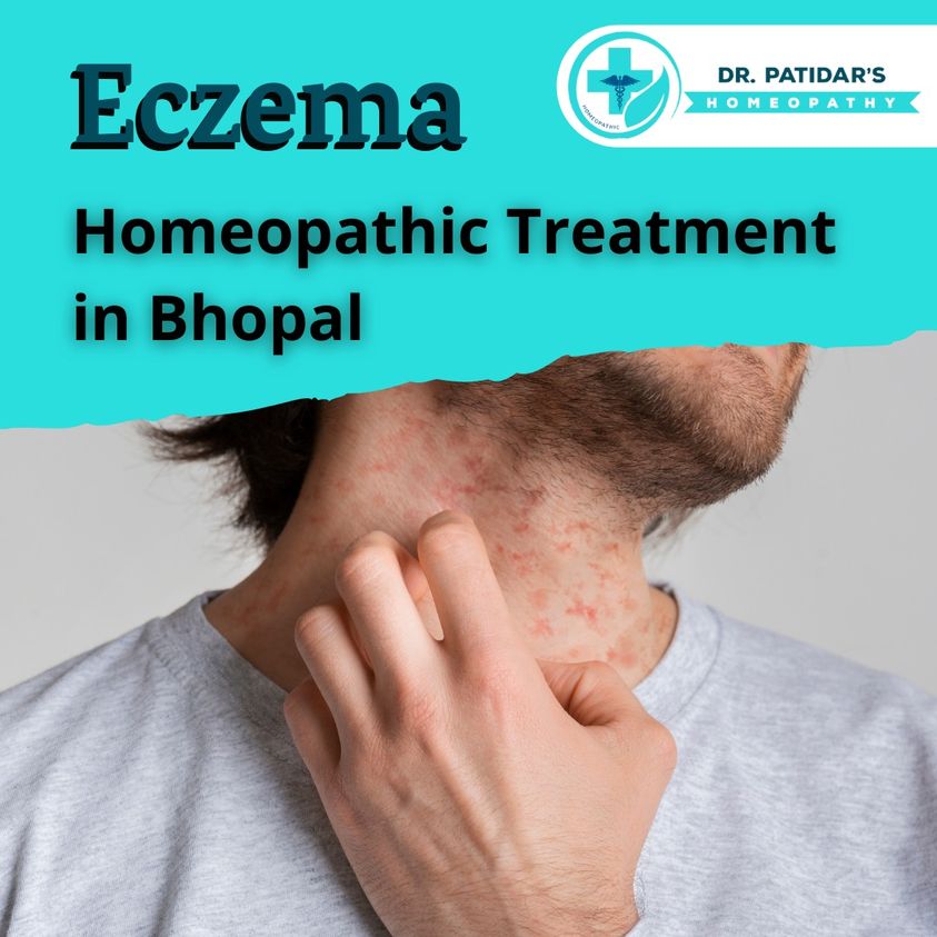 Homeopathic Treatment for Eczema Social Social Social Social Social