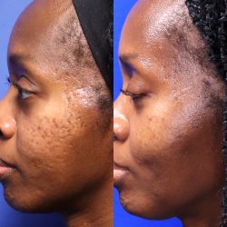Acne scars before and after black skin