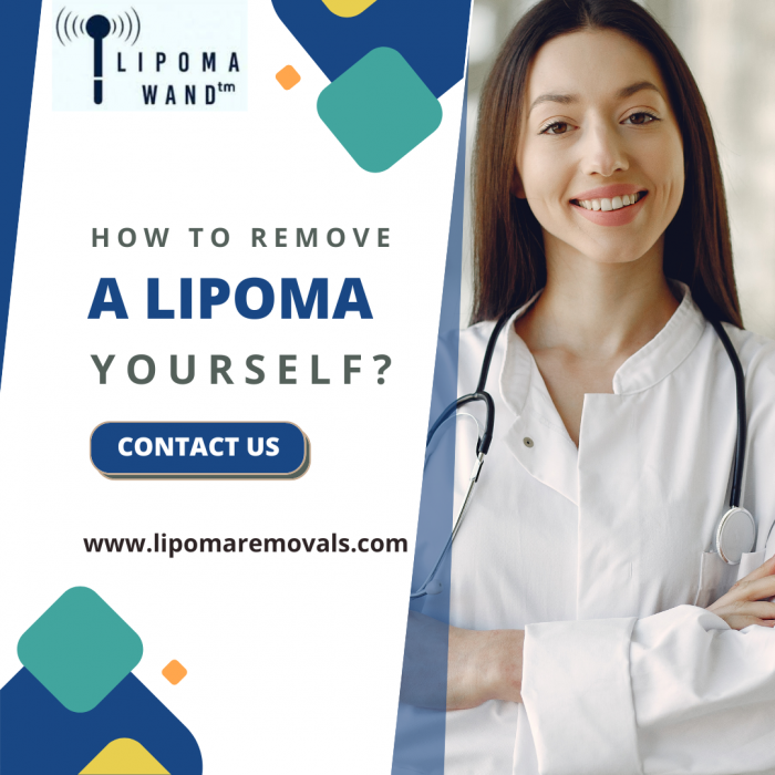How To Remove a Lipoma Yourself?