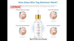 Amarose Skin Tag Remover ‘Reviews update