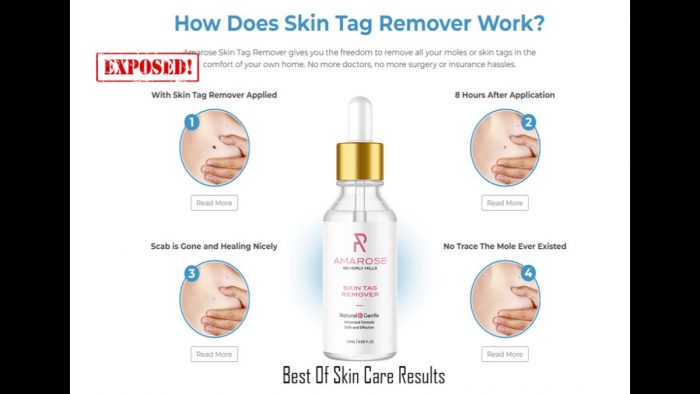 Amarose Skin Tag Remover ‘Reviews update