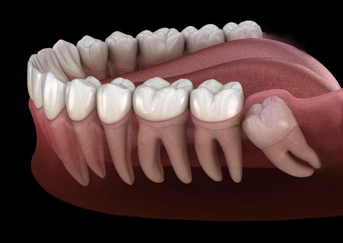 Tooth Extraction Procedure And Treatment