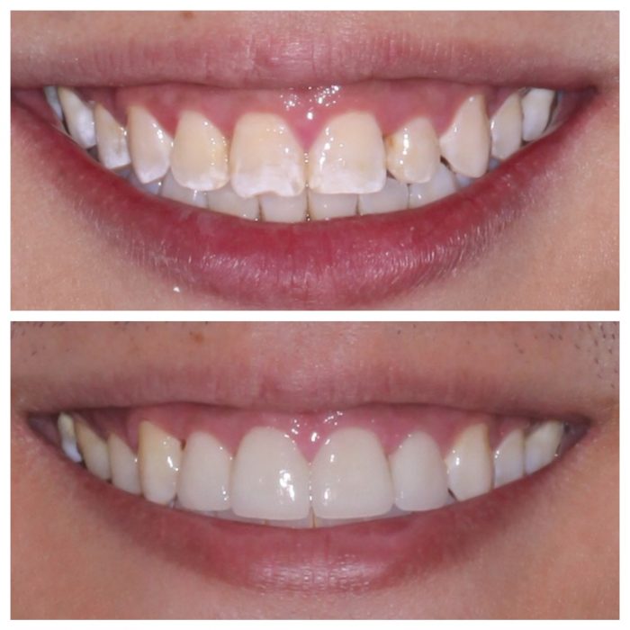 What Is Dental Cosmetic Bonding?