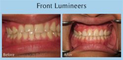 Lumineers San Diego Dentist – Gentle Dentistry