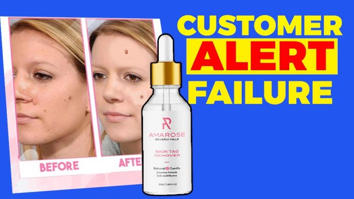 Amarose Skin Tag Remover Review: Scam or Legit Customer Results?