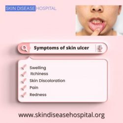 What are the symptoms of skin ulcer ?