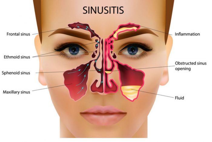 Natural Sinus Treatment in Ayurveda