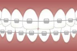 What Is Different In Adult Orthodontics?