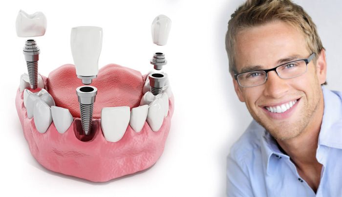 Affordable Dental Implants in Houston TX