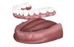 Affordable Dental Implants in Houston TX