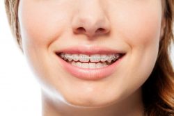 Orthodontic Treatment Options For Adults