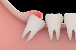 Infected Wisdom Tooth Removal