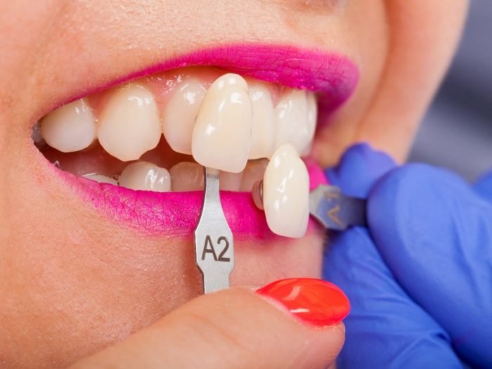 how much do veneers cost?