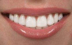 Veneers For Straight Teeth