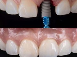 Affordable Dental Implants Clinic