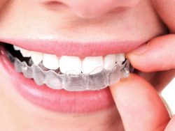 How Much Do Clear Braces Cost?