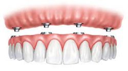 How Long Does It Take To Get Implant Supported Dentures?