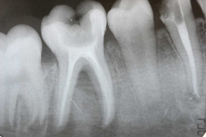 What Is The Best Alternative To A Root Canal?