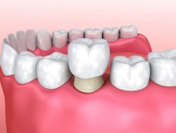 What Are Dental Crowns and How Do They Work | CEREC Dental Crowns