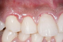 What Is The Best Gingivitis Treatment?