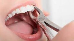 Tooth Extraction Procedure Near Me – Sapphire Smile