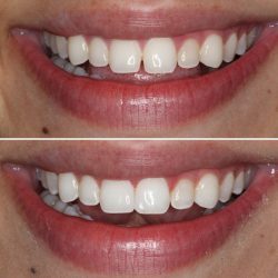 Dental Bonding Houston | Teeth Bonding