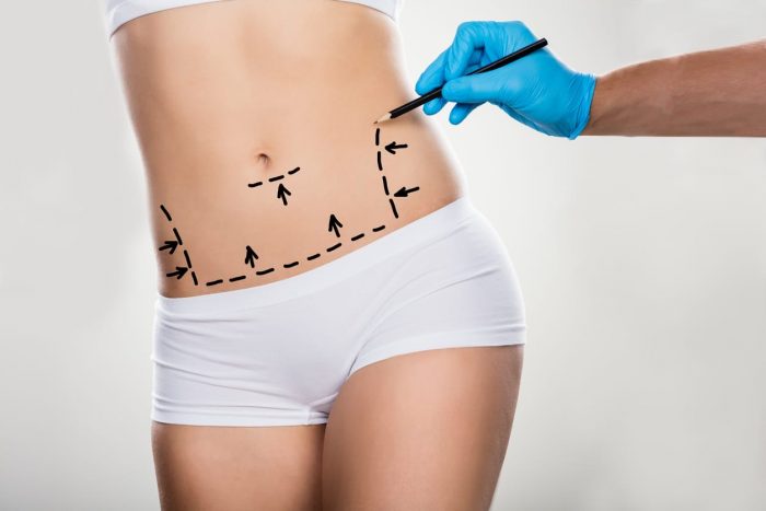 Liposuction Houston TX | Liposuction Near Me | Cosmetic Surgeon