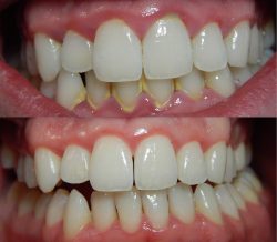 Periodontal Gum Disease Treatmentt