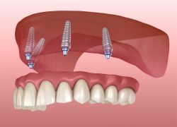 Dental Implant Procedure in Houston