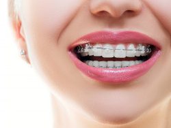 Choose The Best Colors For Your Braces