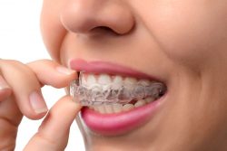 What Is Invisalign Dental Treatment?