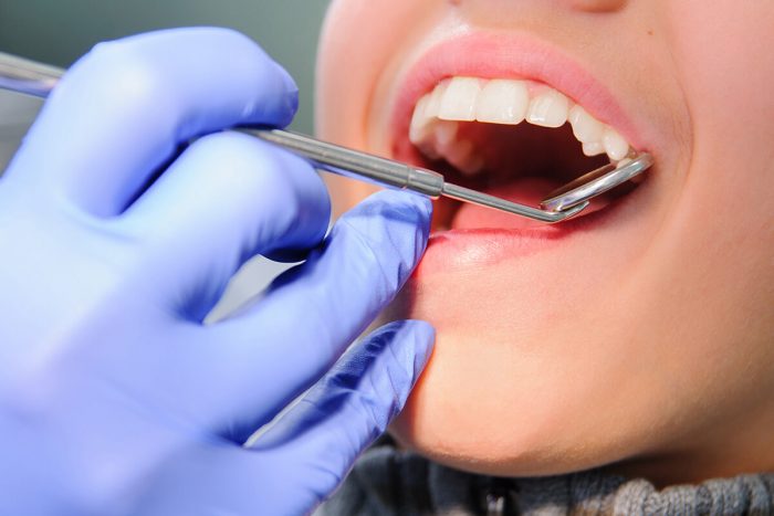 What Are The Benefits Of Getting A Dental Filling?