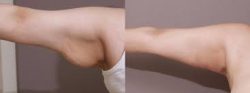 Arm Liposuction Before & After Results Celebrity Arms