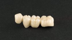 Dental Bridges Houston TX | Missing Teeth