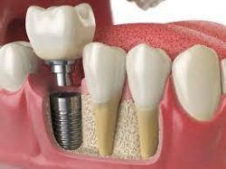 Best Dental Implant Specialist Near Me | Teeth Implants