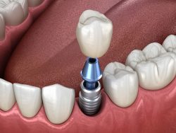 Dental Implants Houston TX – Sapphire Smiles