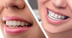 Before and After Braces At The Orthodontic Centre