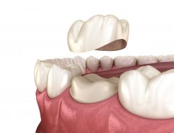 Root Canal Treatment, RCT of Teeth Cost & Procedure