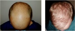 Obtenga Tratamiento Para La Alopecia Androgénica De La Dr. Lourdes Linzoain