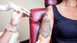 Can Tattoo Removal Cause Cancer?