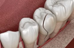Dental Crown Procedure Cost | How to Fix a Broken Crown Tooth