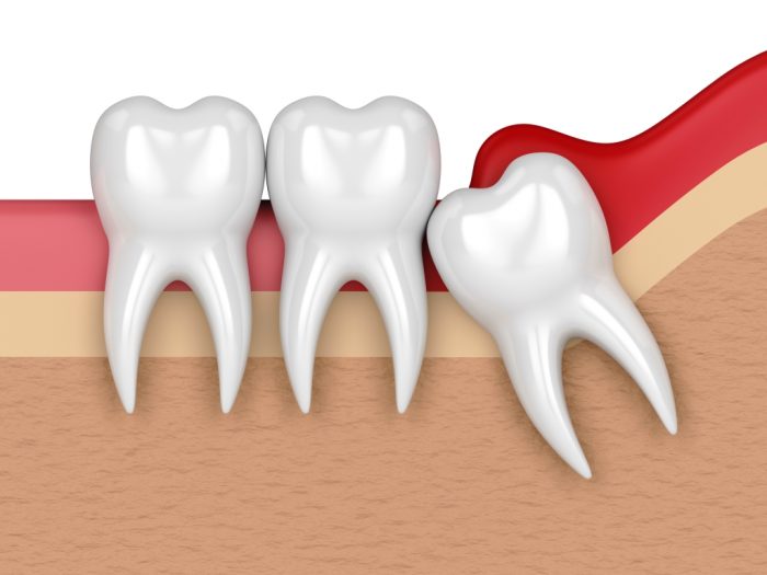 Wisdom Tooth Removal Procedure | Wisdom Tooth Removal Cost