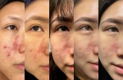 Acne scar treatment using kenalog injection