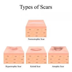 Different types of scars